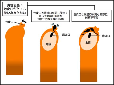 ほうけい 種類|包茎とは？図で仮性・真性・嵌頓の見分け方をわかり。